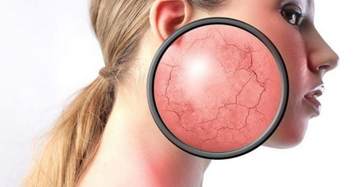 Cách điều trị da bị nhiễm corticoid tại nhà