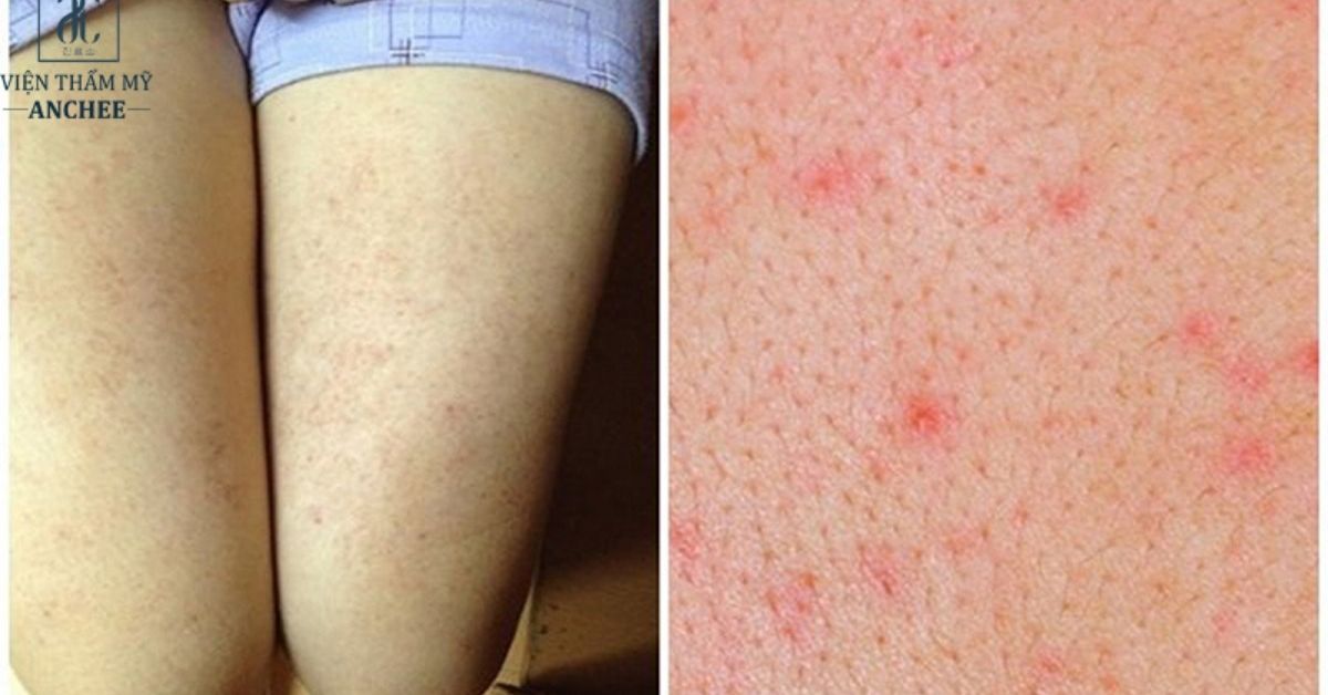 Trị thâm lỗ chân lông ở chân bằng Laser có hiệu quả không