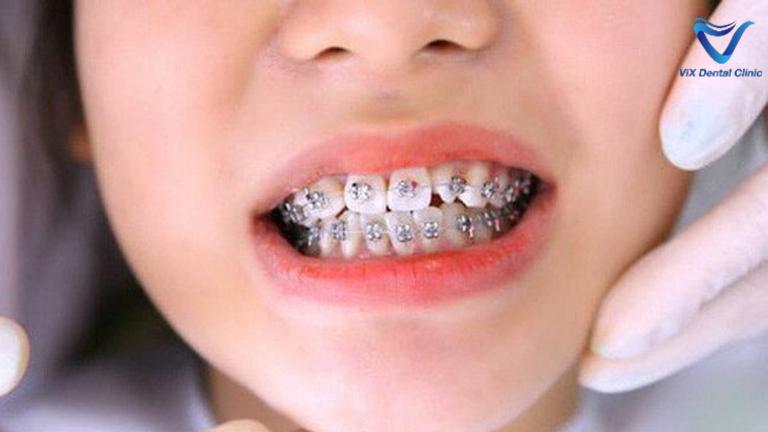 Niềng răng mắc cài giúp khắc phục triệt để tình trạng răng vẩu nặng